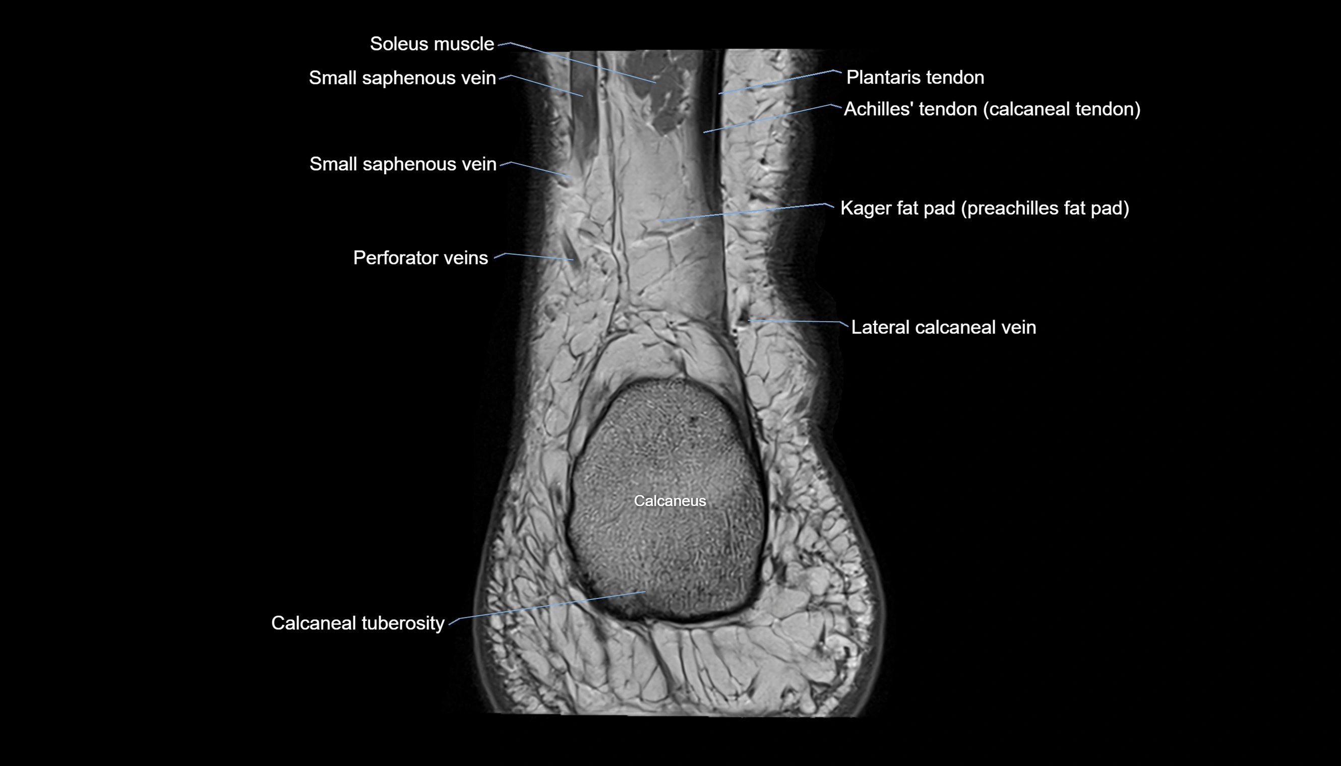 Ankle coronal anatomy 3T MRI images -img-11001-00029.webp
